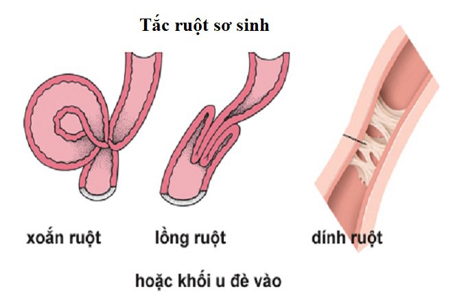 20191023_040500_998759_tac-ruot-o-tre-so-s-max-1800x1800-1-1 Có nhiều nguyên nhân gây tắc ruột ở trẻ