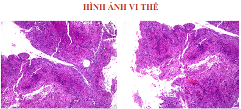 Kết quả xét nghiệm mô bệnh học của bệnh nhân