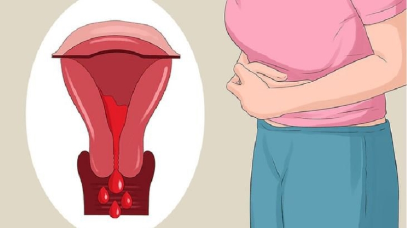 Cẩn trọng trước dấu hiệu chảy máu tử cung bất thường ở nữ giới sau mãn kinh (Ảnh minh họa - Nguồn: Internet)