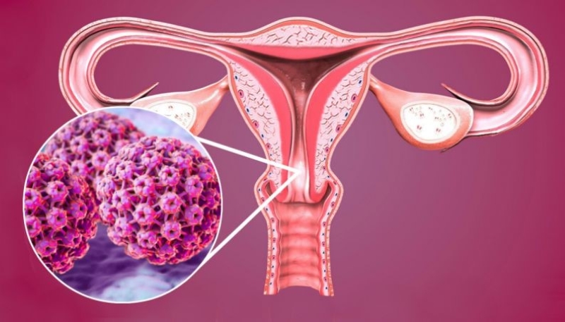 Virus HPV được xác định là thủ phạm chính gây ung thư cổ tử cung