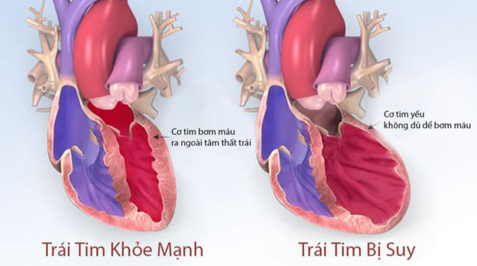 69-2 Trái tim bị suy có rất nhiều biến chứng