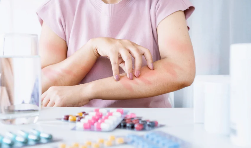 acetylcysteine-3 Thuốc Acetylcysteine có thể gây ra các tác dụng phụ dị ứng như nổi mày đay
