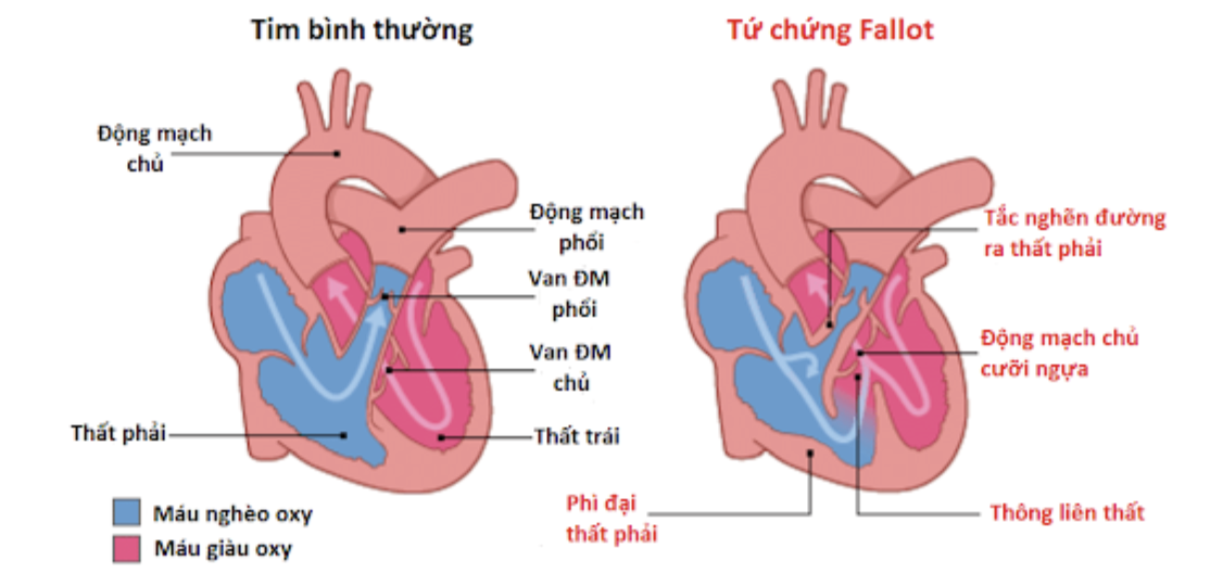 anh-man-hinh-2024-08-18-luc-16-26-57-1 Mô tả cấu trúc tim với tứ chứng Fallot