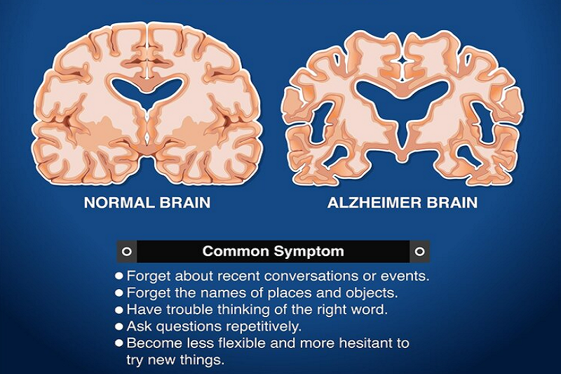 benh-alzheimer-o-nguoi-tre-tuoi-1 Người mắc bệnh Alzheimer gặp vấn đề về trí nhớ, thay đổi bất thường về hành vi
