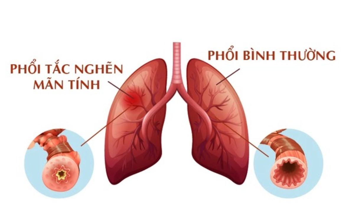benh-phoi-anh-huong-den-tim-1 Phổi tắc nghẽn mãn tính và phổi thường