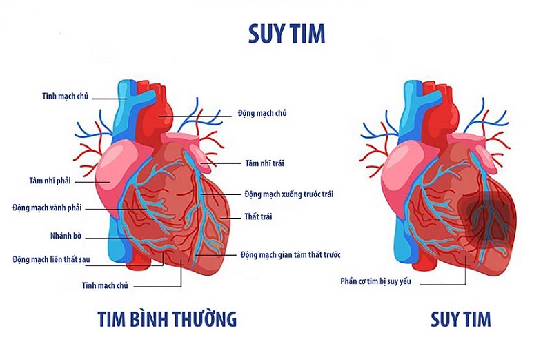 bien-chung-nhoi-mau-co-tim-1-1 Suy tim là biến chứng thường gặp ở người bị nhồi máu cơ tim cấp