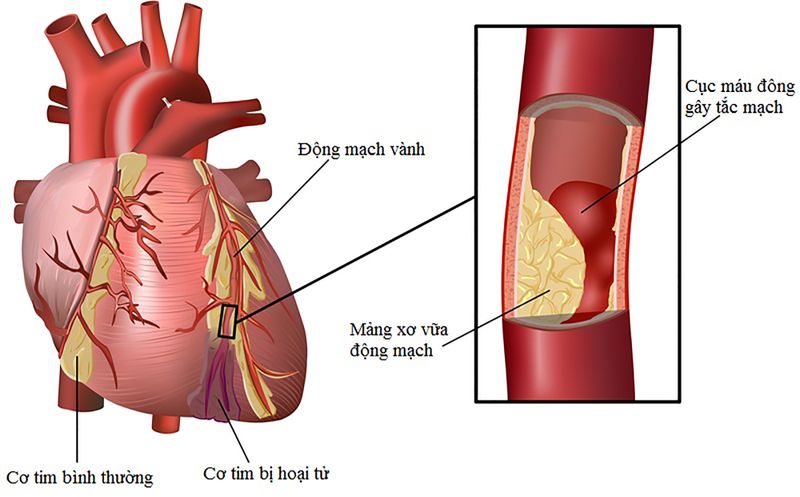 by8kkbql-nhoi-mau-co-tim-1 Nhồi máu cơ tim là nguyên nhân gây tử vong hàng đầu trong các bệnh tim mạch