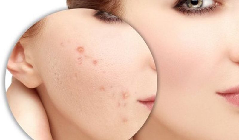 bzjnhza7-da-1-1 Cách chăm sóc da sau điều trị sẹo và mờ vết thâm