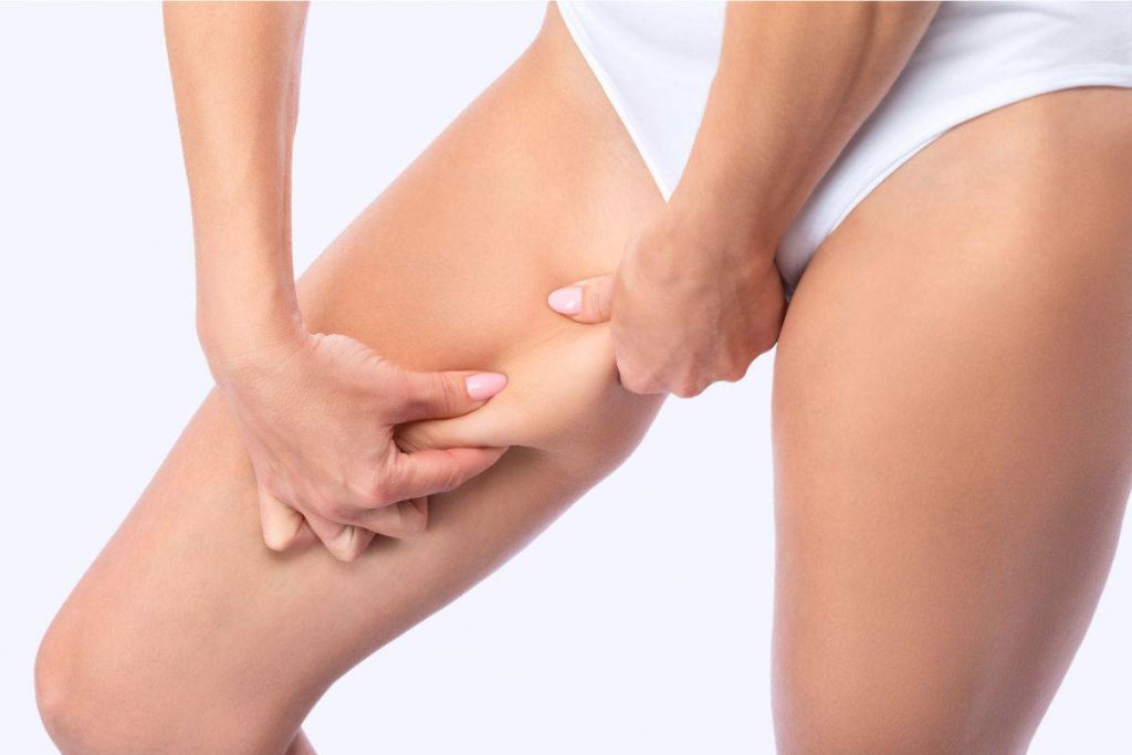 Nguyên nhân tích mỡ đùi là do đâu? 6 cách giảm mỡ đùi hiệu quả