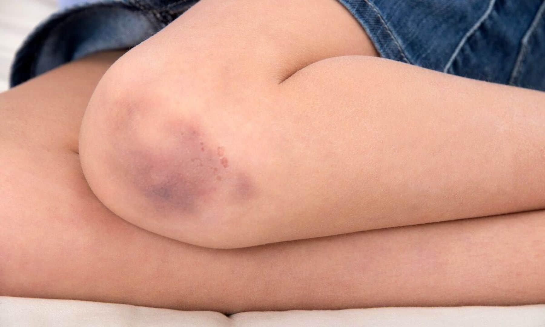 cách xử lý khi bị tụ máu bầm