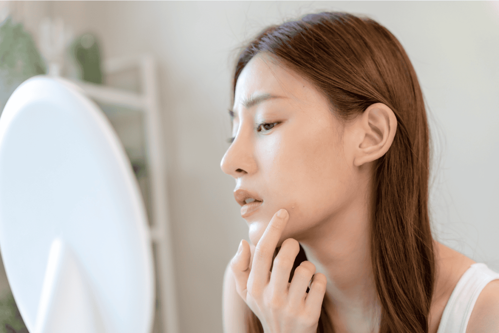 Cách lấy nhân mụn không cần nặn