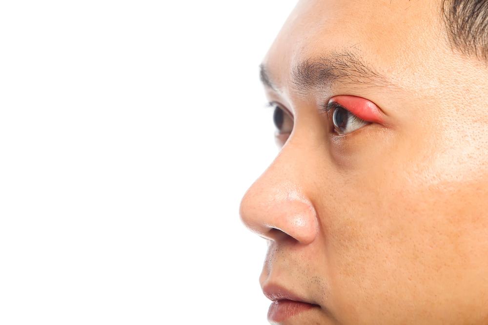 Biết cách chăm sóc mắt sau khi chích lẹo để sớm bình phục