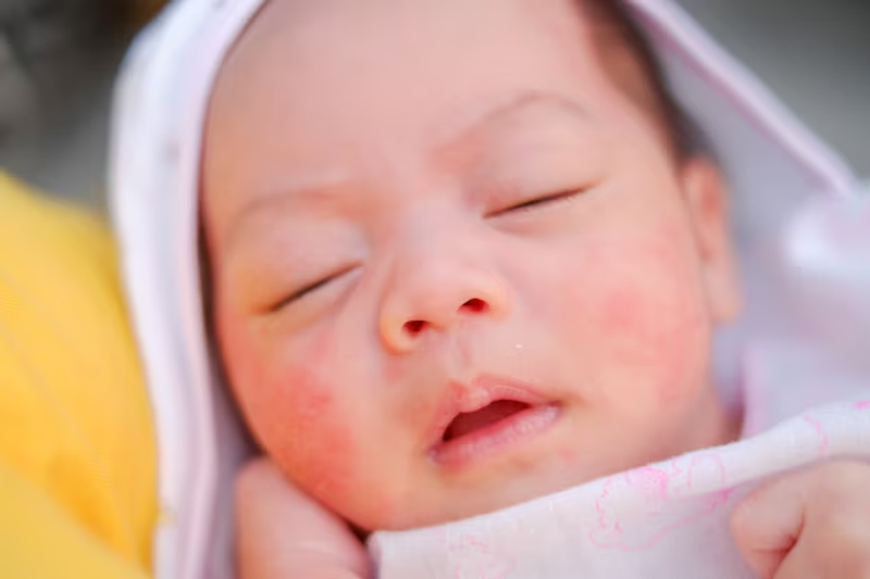 cham-sua-o-tre-so-sinh-1-1 Chàm sữa ở trẻ sơ sinh với vùng da 2 bên má bị nổi nốt đỏ và mụn nước