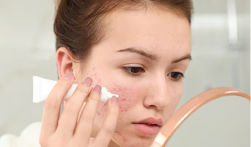 Bôi kem trị mụn bao lâu thì rửa mặt bao lâu thì rửa mặt phụ thuộc vào kết cấu của loại kem
