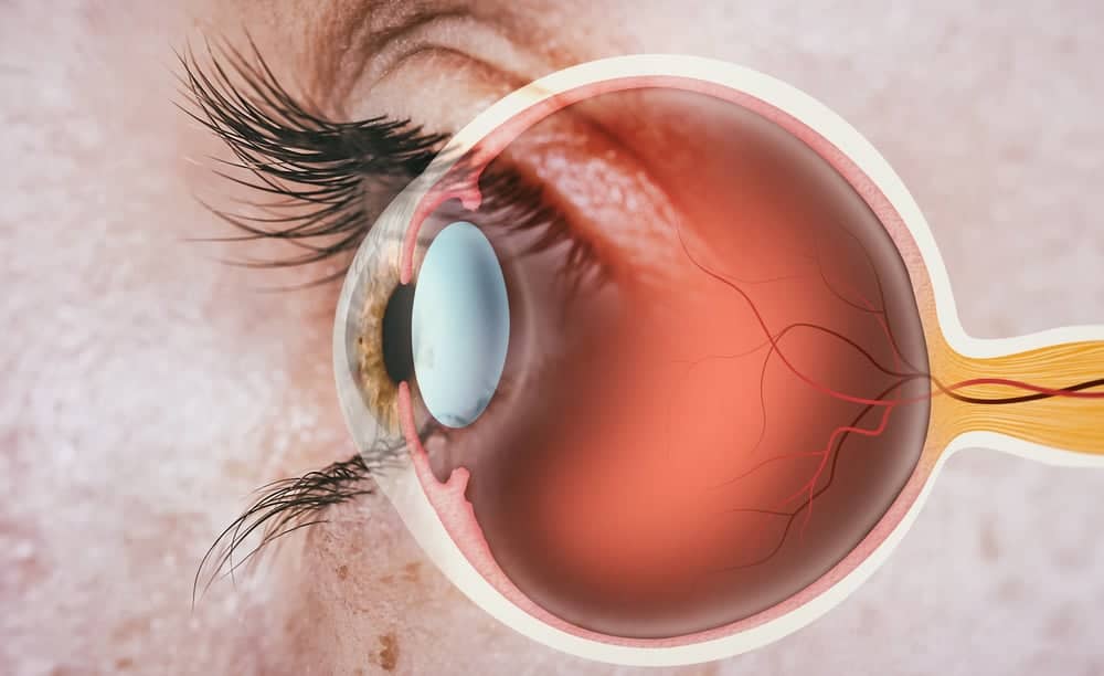 biến chứng của bệnh võng mạc tăng huyết áp