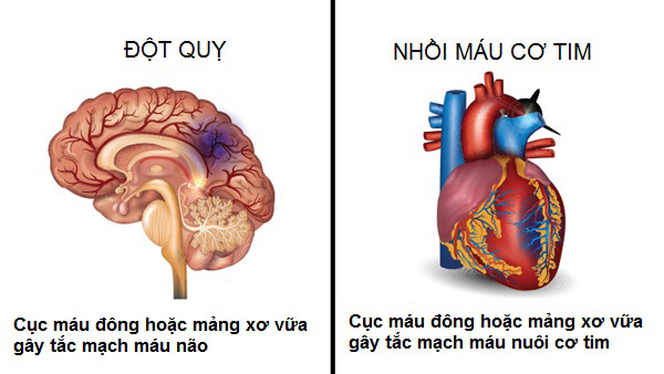 dot-quy-nhoi-mau-co-tim-1 Phân biệt đột quỵ và nhồi máu cơ tim.
