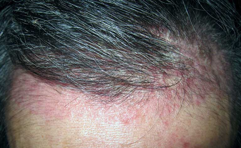 goi-dau-4 Viêm da tiết bã- nguyên nhân dẫn đến da đầu dầu