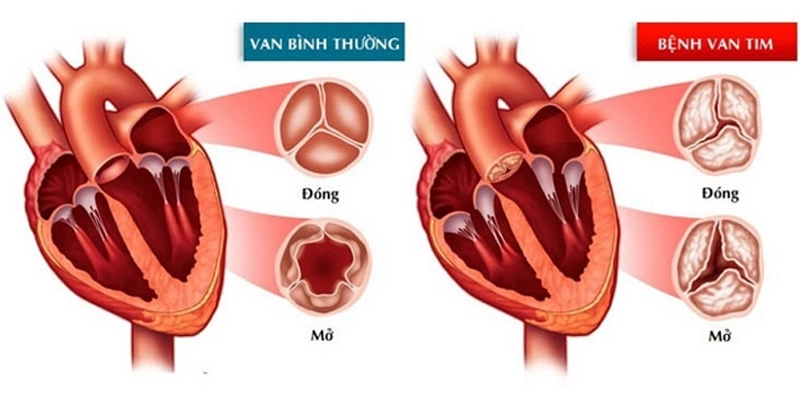 ho-van-tim-song-duoc-bao-lau-1 Hình ảnh minh họa van tim bình thường và van tim bị hở