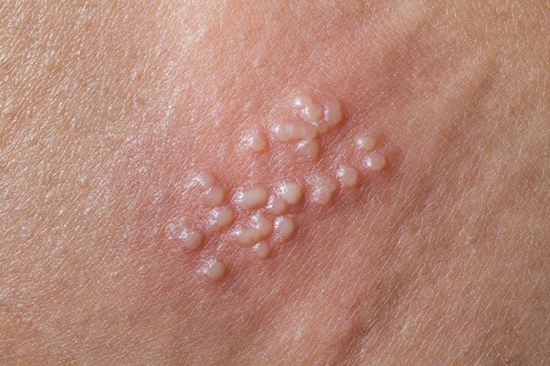 Nổi mụn cóc sinh dục là một trong các dấu hiệu nhiễm HPV ở phụ nữ