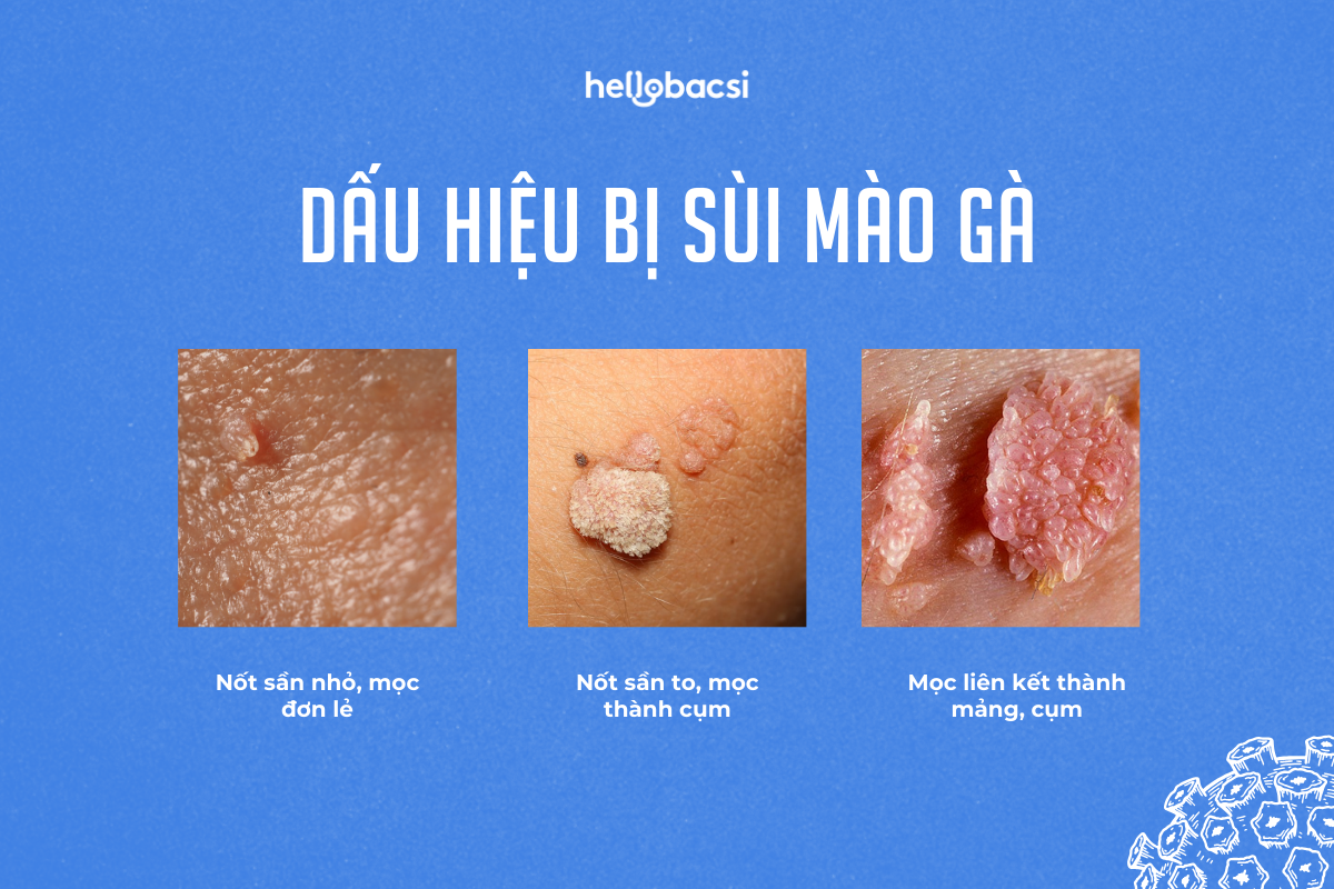 hpv-lay-qua-duong-nao_574123-5 HPV lây qua đường nào