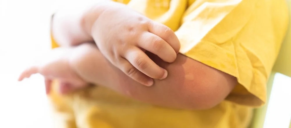 Cảnh giác khi dịch sốt xuất huyết tăng mạnh, đừng nhầm lẫn sốt xuất huyết và sốt thông thường