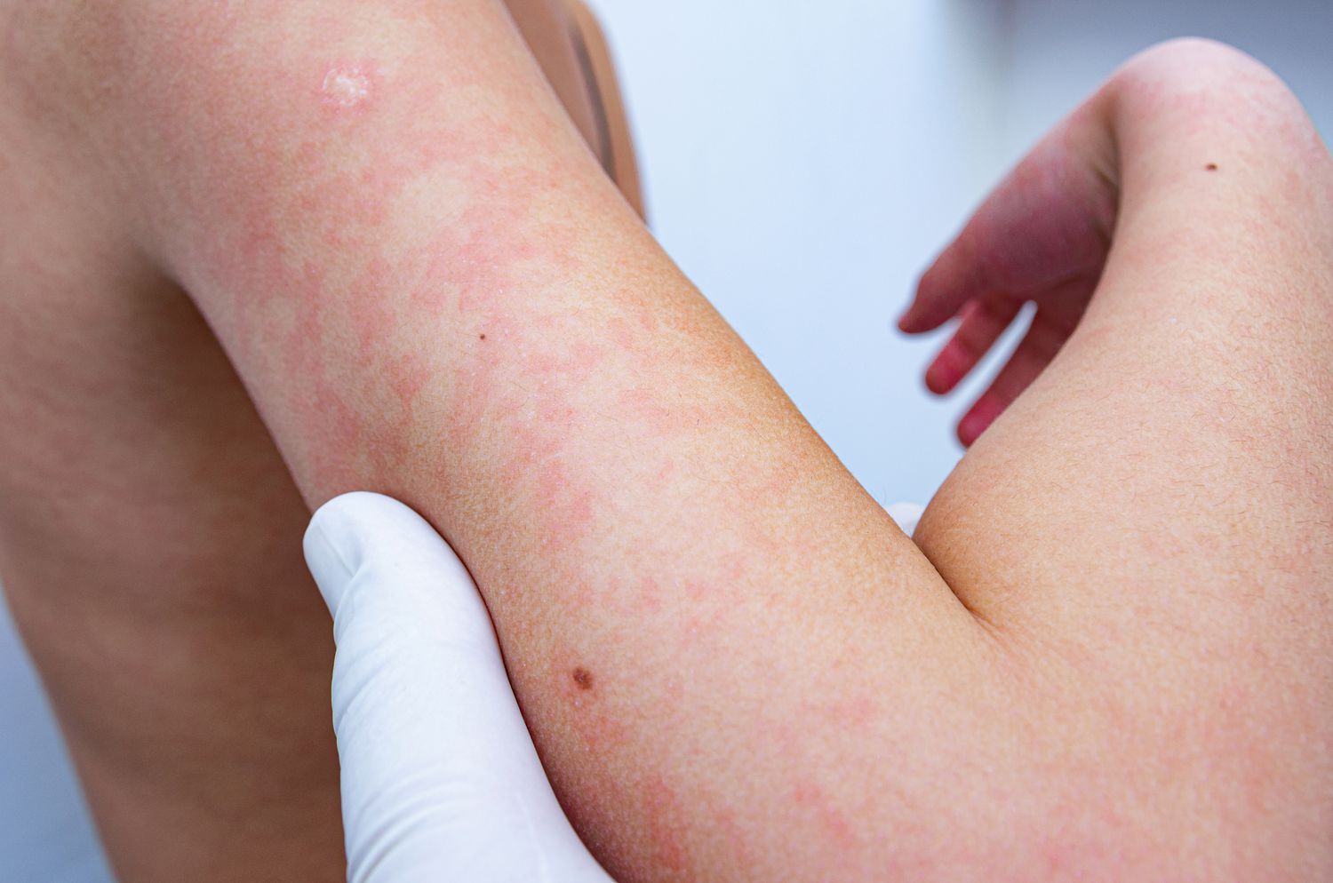irbesartan-3 Lưu ý một số tác dụng phụ có thể xảy ra khi sử dụng thuốc Irbesartan