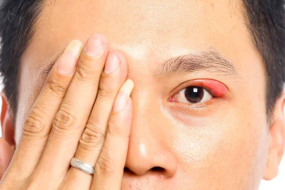 khi-nao-can-chich-leo-mat khi nào cần chích lẹo mắt?