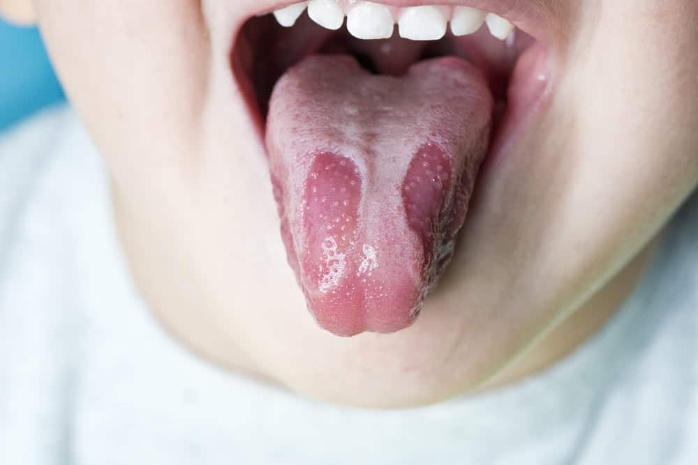 lưỡi nổi hạt trắng do bệnh lưỡi bản đồ
