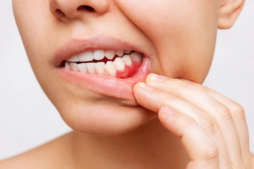 miconazole-3 Thuốc Miconazole có thể gây ra các tác dụng phụ về vấn đề răng miệng