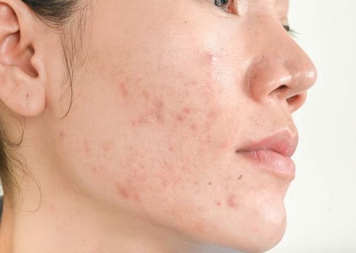 mun-tham-1 Có rất nhiều nguyên nhân khiến thâm mụn xuất hiện