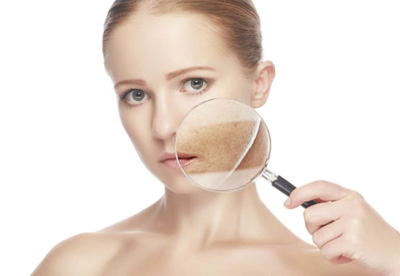 Nám hỗn hợp thường gặp ở phụ nữ ở độ tuổi ngoài 30