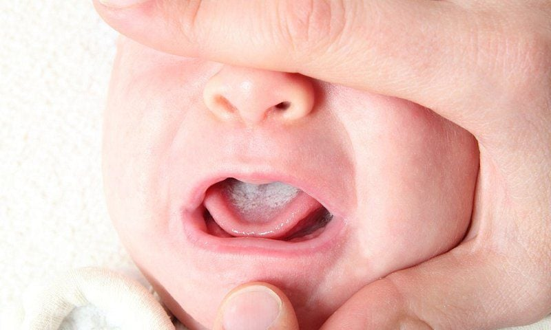 Trẻ bị nấm miệng với mảng màu trắng đục trên bề mặt lưỡi