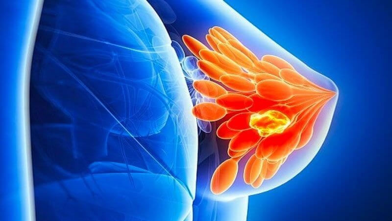 Nang vú là tình trạng phổ biến ở nữ giới