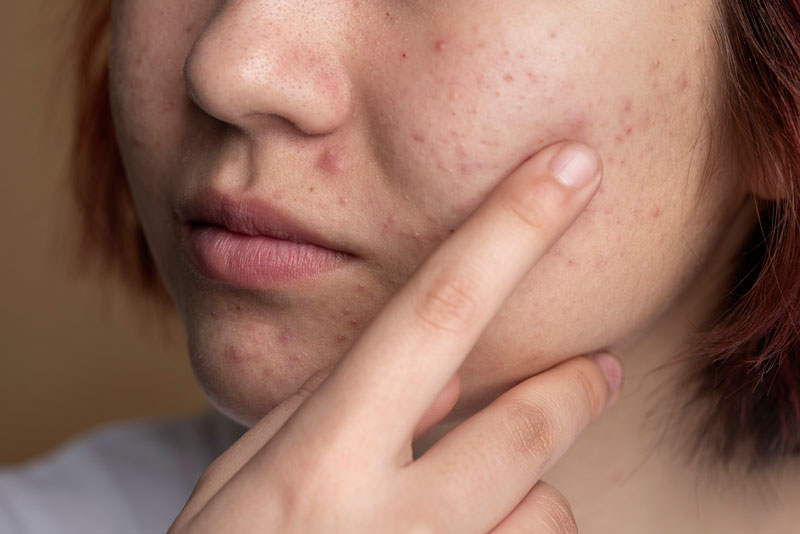 Người dễ bị nhiễm Herpes trên vùng da mặt không nên tiêm Hyaluronic Acid