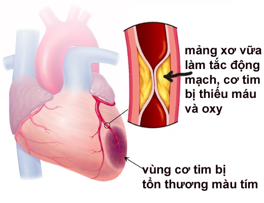 nhoi-mau-co-tim-1 Nhồi máu cơ tim