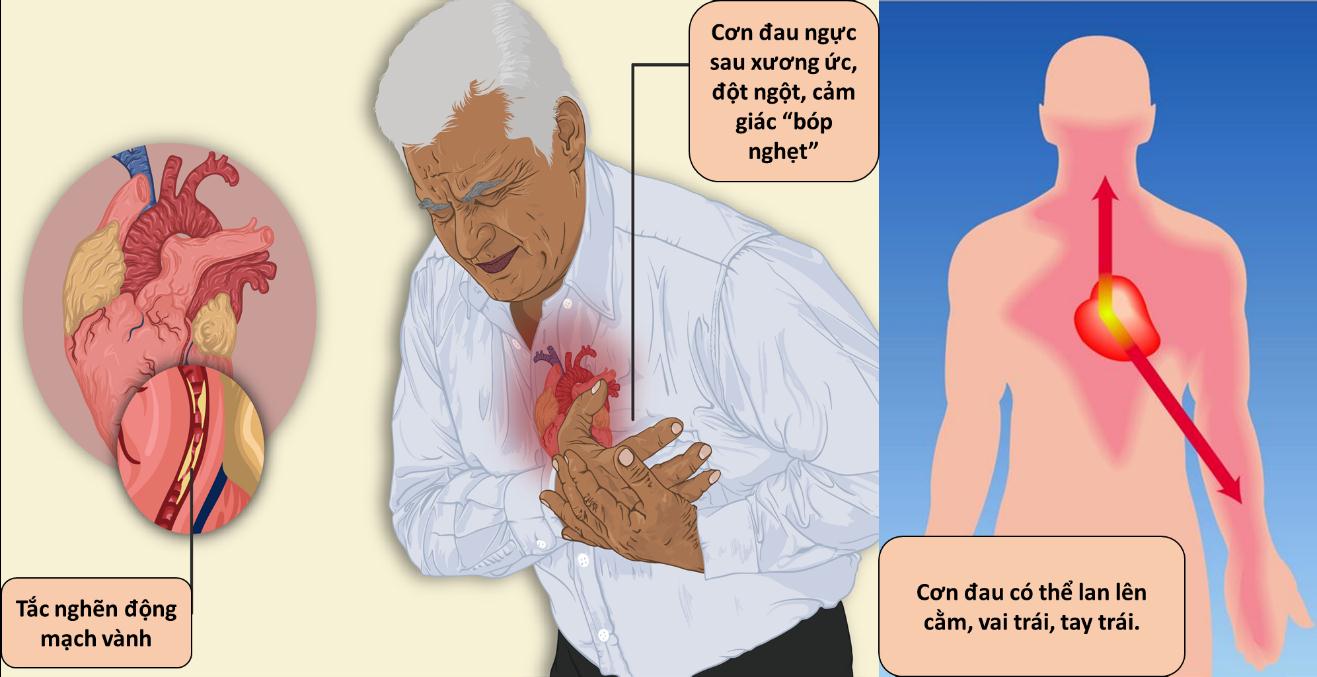nhoi-mau-co-tim-2 Triệu chứng của nhồi máu cơ tim