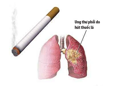 nn-ung-thu-phoi-1-1 Ung thư phổi do hút thuốc lá