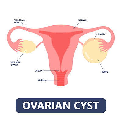 ovarian-cyst-1 U bì buồng trứng là một loại u nang buồng trứng thường lành tính