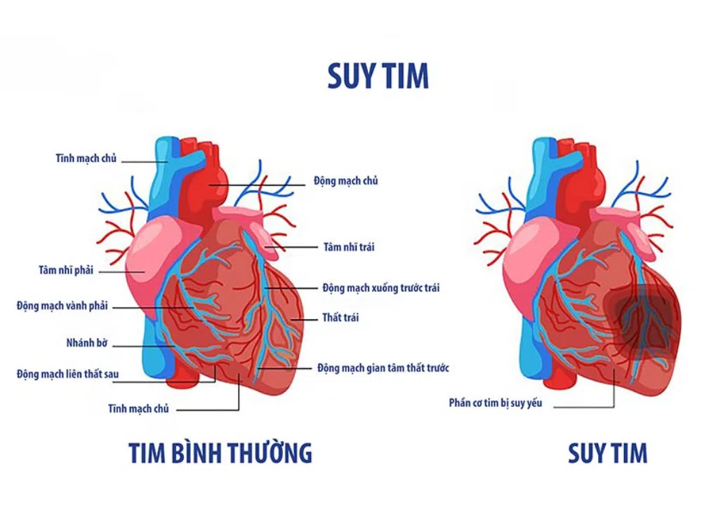 phan-biet-tim-binh-thuong-va-suy-tim Mối quan hệ giữa bệnh phổi tắc nghẽn mãn tính và suy tim