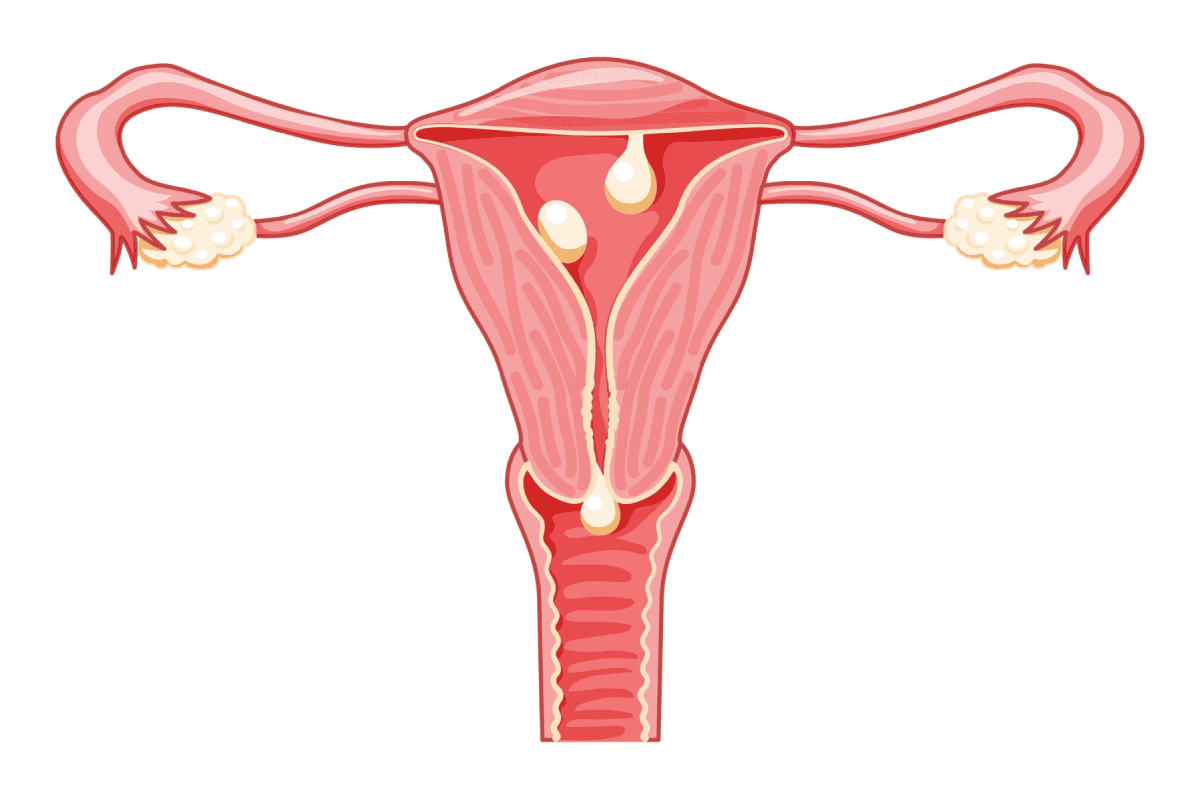 sau quan hệ ra máu có phải mang thai không: do polyp tử cung