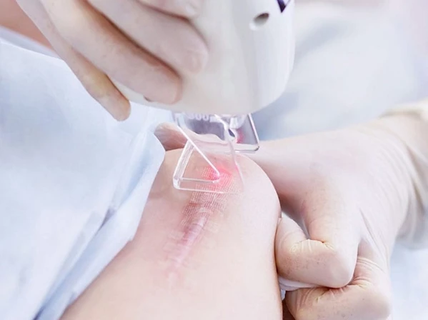 seo-loi-1-1 Liệu pháp laser điều trị sẹo lồi