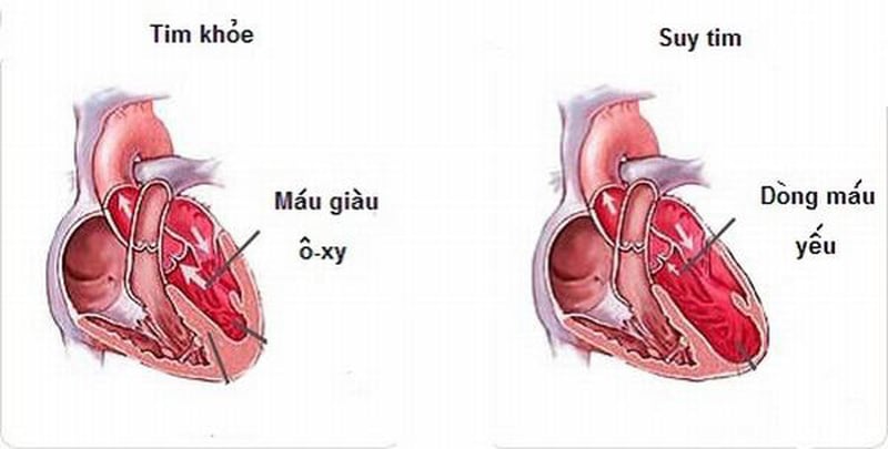suy-tim-gd-cuoi-anh-huong-cs-1 Suy tim