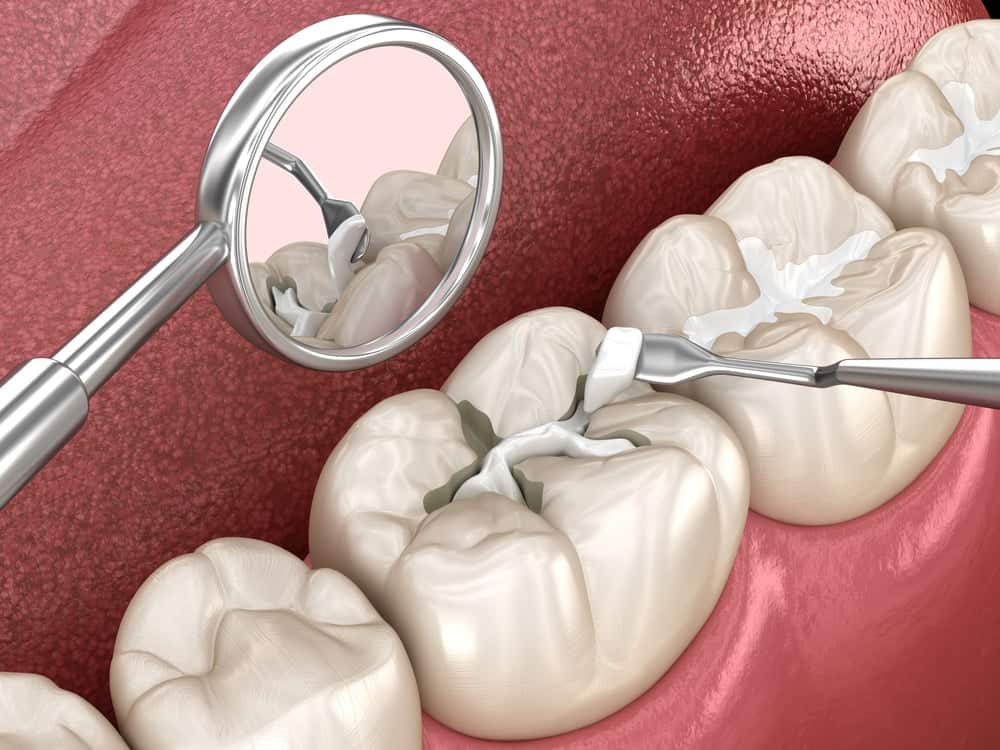 7 tác hại của việc trám răng sai kỹ thuật