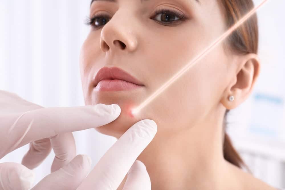 tẩy nốt ruồi bao nhiêu tiền tùy vào nơi thực hiện