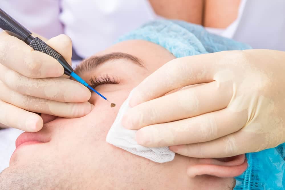 tẩy nốt ruồi bao nhiêu tiền tùy vào số lượng nốt ruồi
