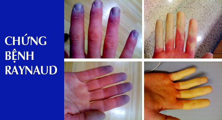 te-bi-tay-chan-2 Hình ảnh bàn tay bị bệnh/hội chứng Raynaud