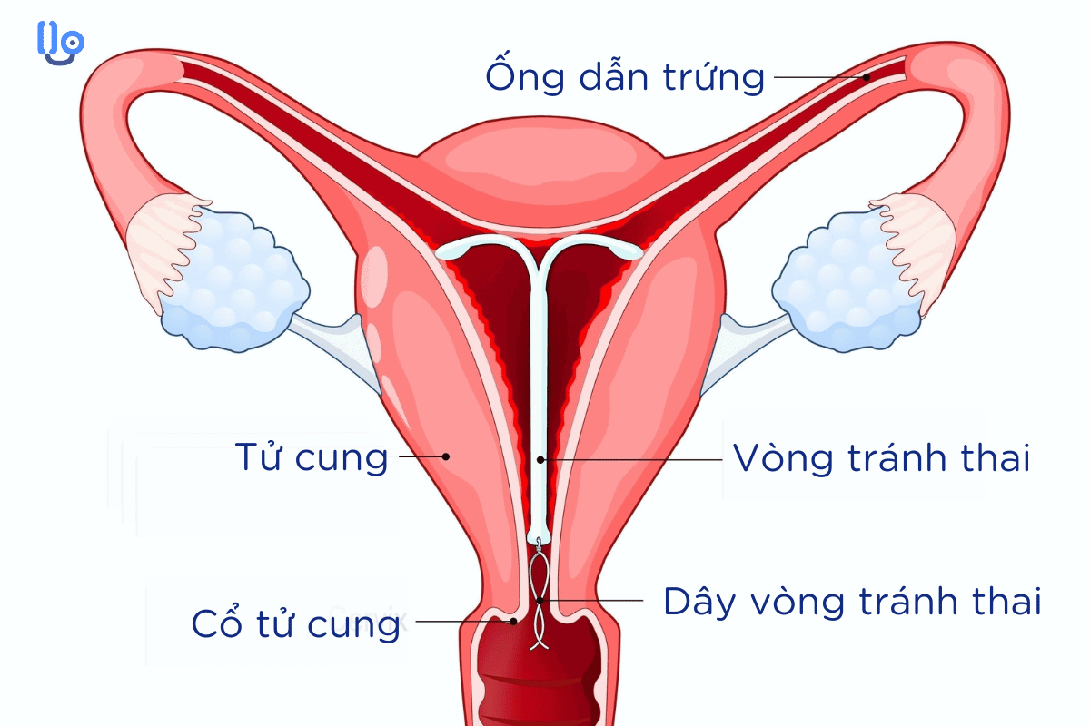 thao-vong-tranh-thai-bao-lau-thi-dat-lai-duoc Tháo vòng tránh thai bao lâu thì đặt lại được