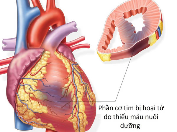 thieu-mau-tim-2-1 Cơ tim bị hoại tử.