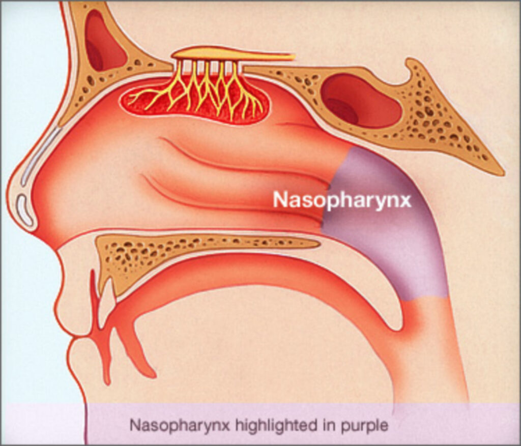 ut-mui-hau-1-1024x877-1 Ung thư mũi hầu (nasopharyngeal cancer – NPC)