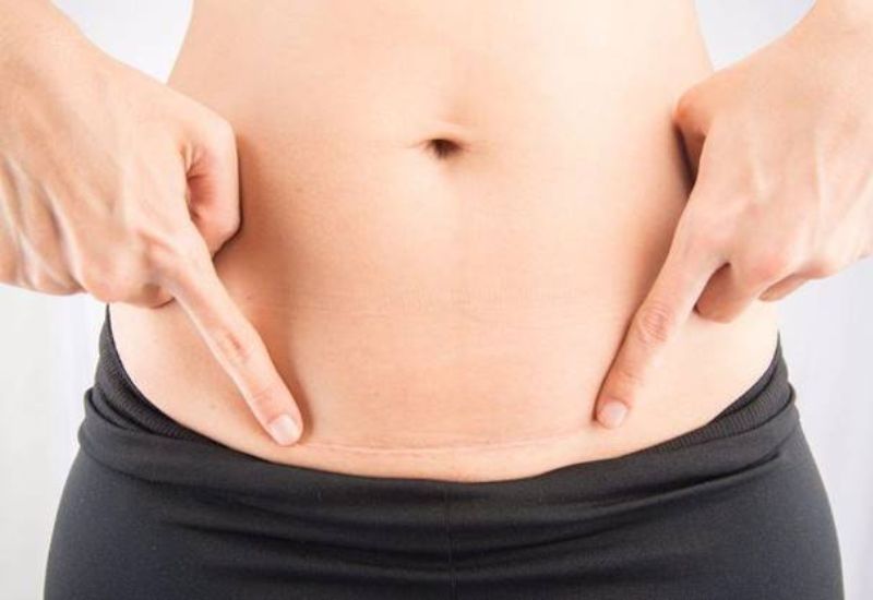 vet-mo-sau-sinh-bi-ngua-1 Tình trạng vết mổ sau sinh bị ngứa chủ yếu bắt nguồn từ quá trình cơ thể mẹ đang phục hồi và tái tạo mô da